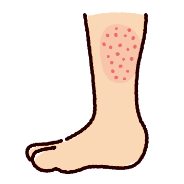 発疹のイラスト（足）（2カット）