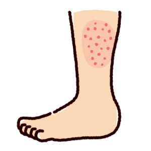 発疹のイラスト（足）